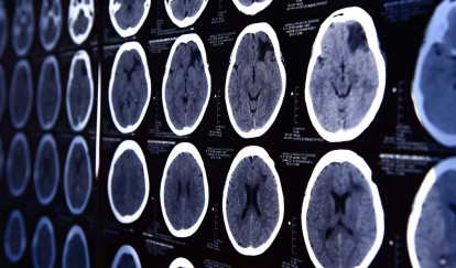 Recoverable Damages in Richmond Traumatic Brain Injury Cases