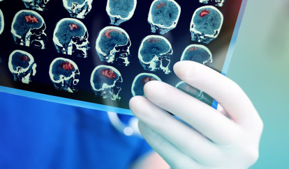 What to Look for in a Richmond Traumatic Brain Injury Lawyer