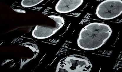 Evidence in Richmond Traumatic Brain Injury Cases